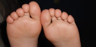 족저근막염(Plantar Fasciitis) 치료는?